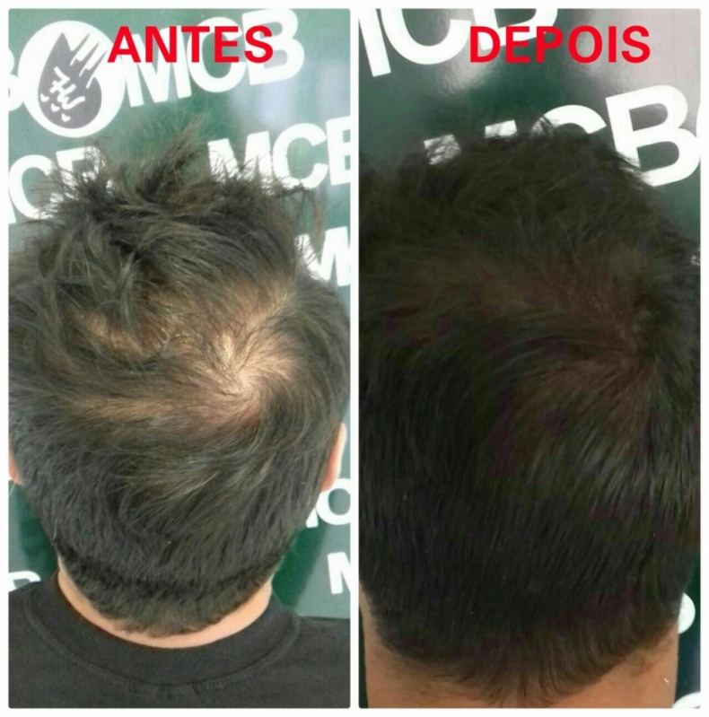 Onde Encontrar Clínica de Pigmentação Capilar para Homens Sapopemba - Clínica de Micropigmentação Capilar