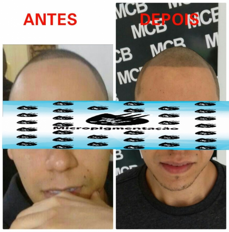 Onde Encontrar Clínica de Pigmentação de Cabelo Masculino Ribeirão Pires - Clínica de Micropigmentação