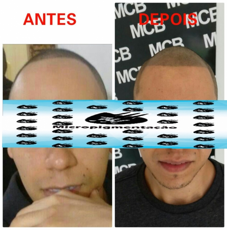 Onde Encontrar Clínica de Pigmentação de Cabelo Masculino Santana - Clínica de Micropigmentação Capilar