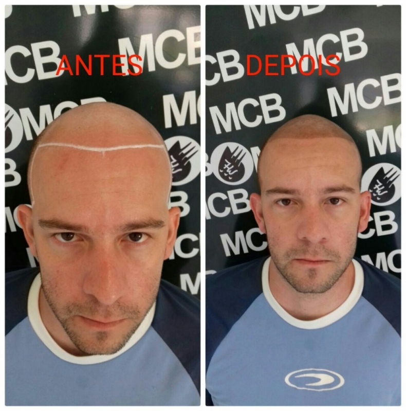 Onde Encontrar Clínica de Pigmentação na Careca Vila Esperança - Clínica de Pigmentação de Cabelo Masculino