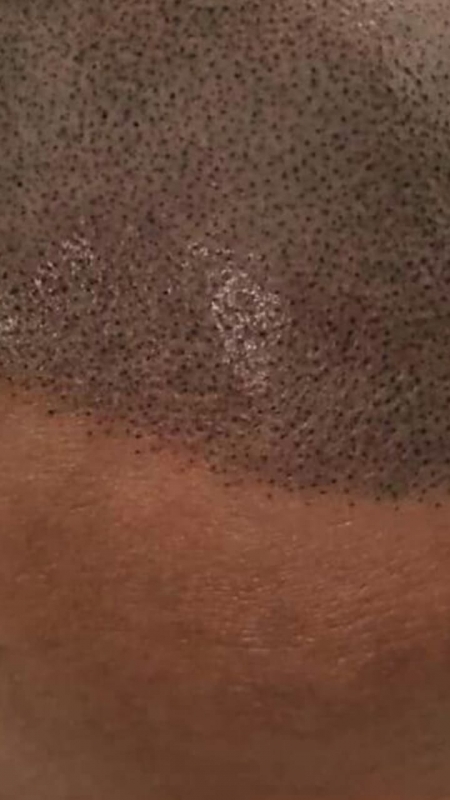 Onde Encontro Clínica de Micropigmentação Capilar em 3d Moema - Clínica de Micropigmentação Capilar