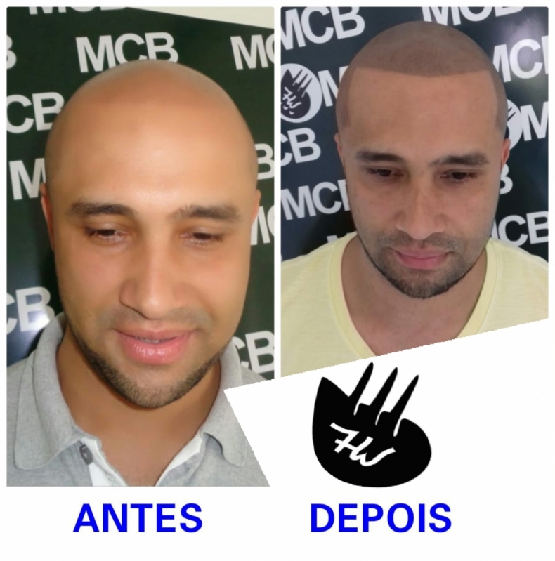 Onde Encontro Clínica de Micropigmentação Capilar Alto da Lapa - Clínica de Pigmentação de Cabelo Masculino