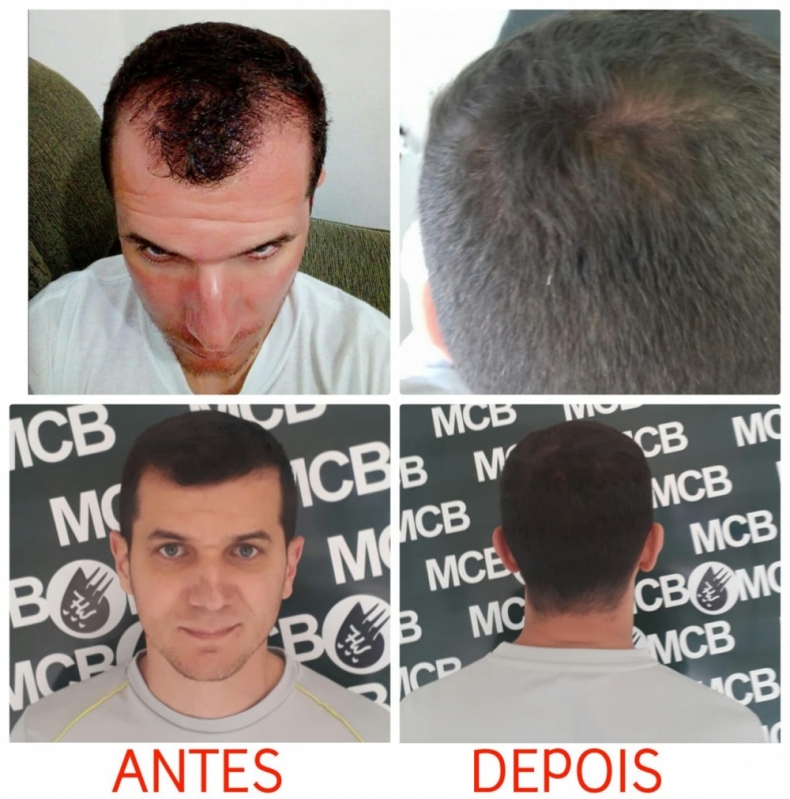 Onde Encontro Clínica de Pigmentação Capilar em Entradas Belém - Clínica de Pigmentação de Cabelo Masculino