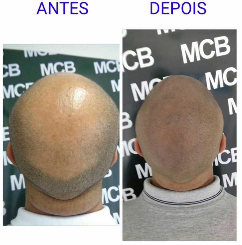 Onde Encontro Clínica de Pigmentação Capilar para Homens Santana - Clínica de Pigmentação de Cabelo Masculino