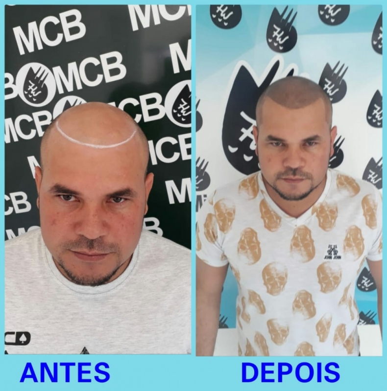 Onde Encontro Clínica de Pigmentação Capilar Jabaquara - Clínica de Micropigmentação Capilar