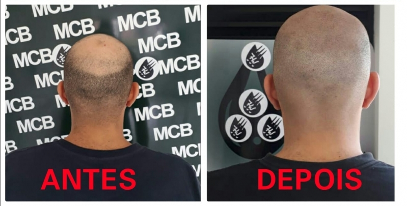 Onde Encontro Clínica de Pigmentação de Cabelo Masculino Jockey Club - Clínica de Micropigmentação Capilar