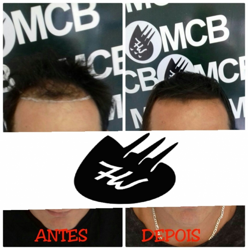 Onde Encontro Clínica de Pigmentação de Couro Cabeludo Artur Alvim - Clínica de Micropigmentação Capilar