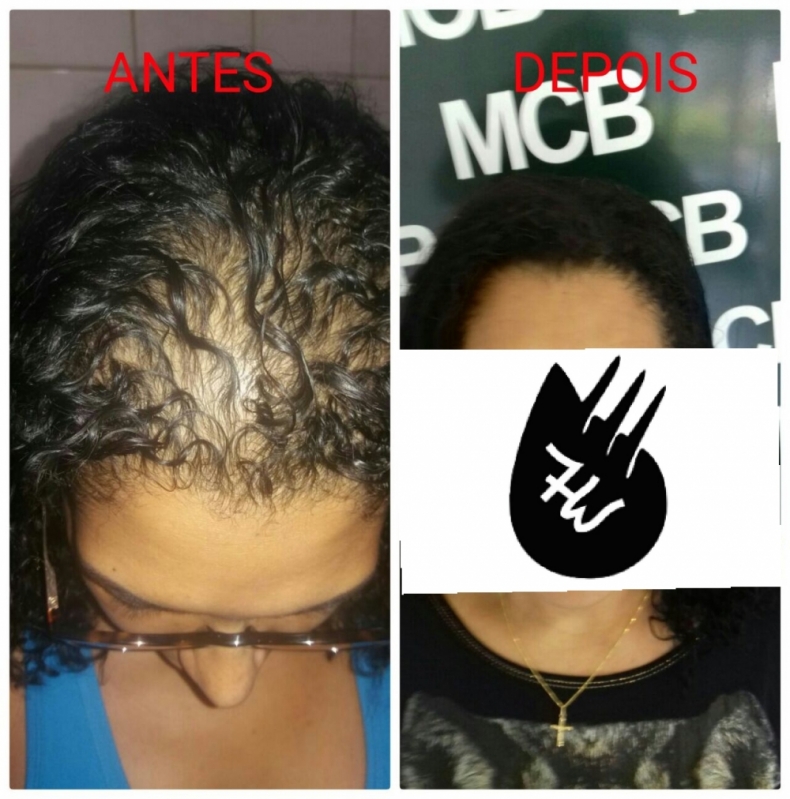 Onde Encontro Micropigmentação Capilar Feminina Carapicuíba - Micropigmentação Capilar Masculina