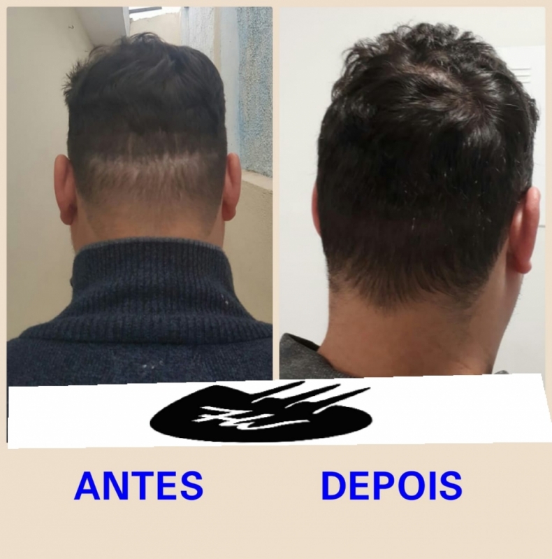 Onde Encontro Preenchimento Capilar com Micro Ponto Bertioga - Preenchimento Capilar Masculino