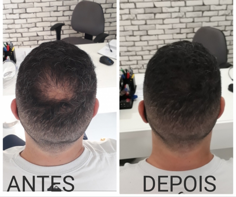 Onde Fazer Micropigmentação Capilar Cabelo Branco Vila Curuçá - Micropigmentação de Cabelo 3d