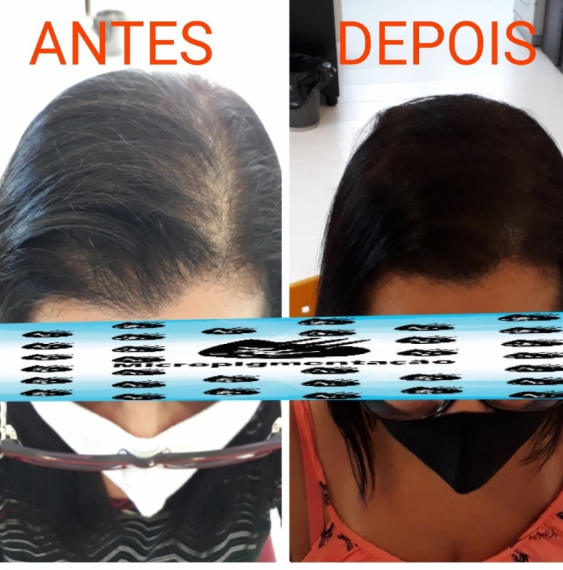 Onde Fazer Micropigmentação Capilar Cabelo Grande São Domingos - Micropigmentação de Cabelo