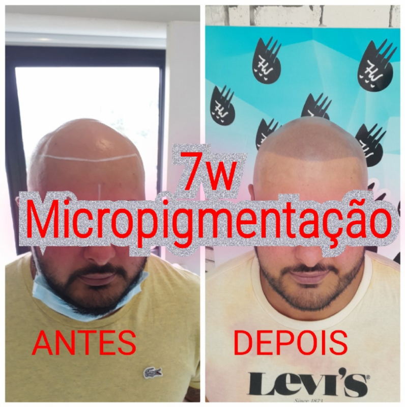 Onde Fazer Nano Pigmentação na Barba ABC Paulista - Nano Micropigmentação de Barba Mauá