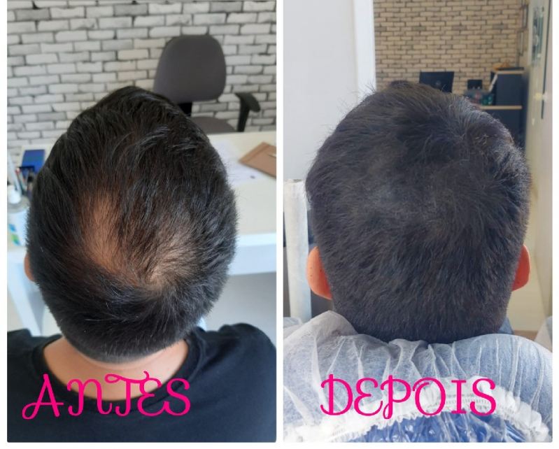 Onde Fazer Nano Pigmentação no Cabelo Jardim Bonfiglioli - Nano Micropigmentação de Barba Mauá