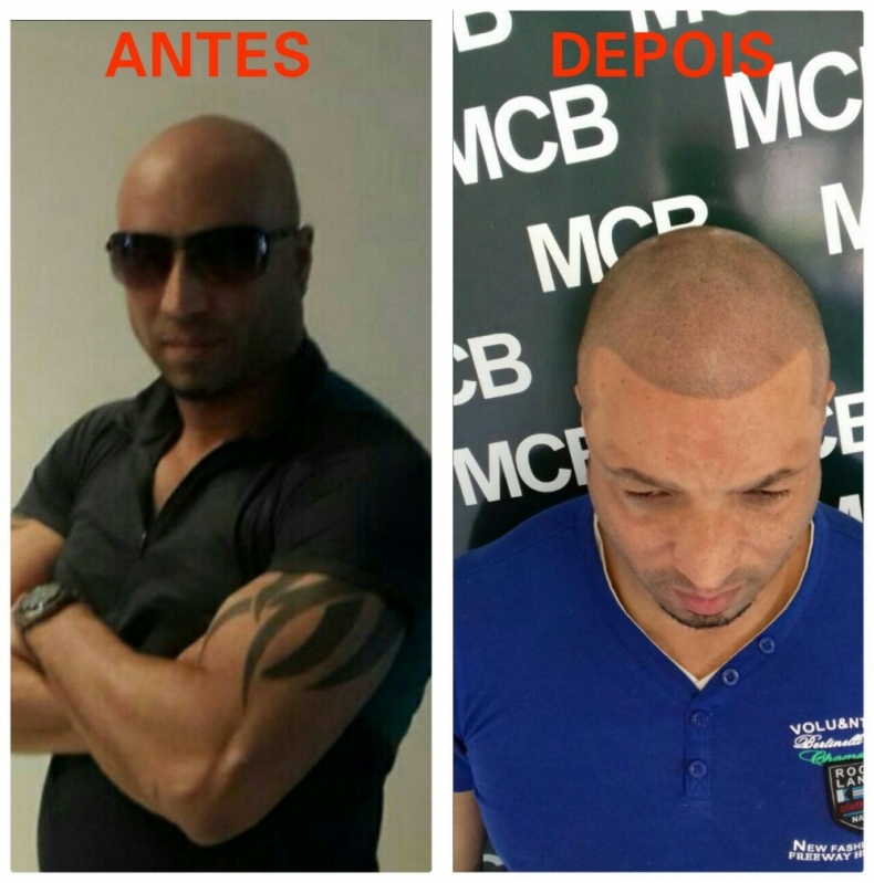 Pigmentação Capilar para Homens Valor Vila Andrade - Pigmentação na Careca