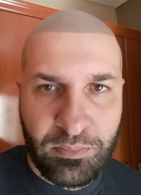 Pigmentação na Careca Artur Alvim - Pigmentação Capilar em 3d