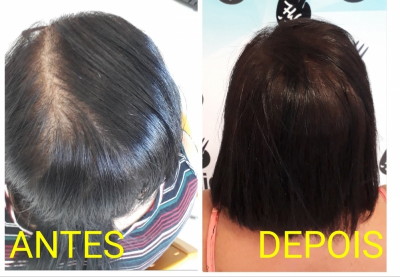 Preço de Micropigmentação Capilar Cabelo Grande Itaquaquecetuba - Micropigmentação Cabelo Masculino