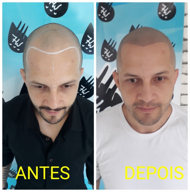 Preço de Micropigmentação Capilar Fio a Fio 3d Embu das Artes - Micropigmentação de Cabelo Masculino