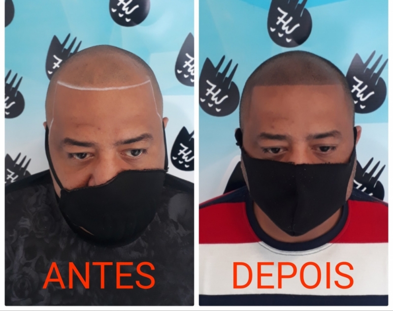 Preço de Micropigmentação Capilar Fio a Fio Santos - Micropigmentação de Cabelo