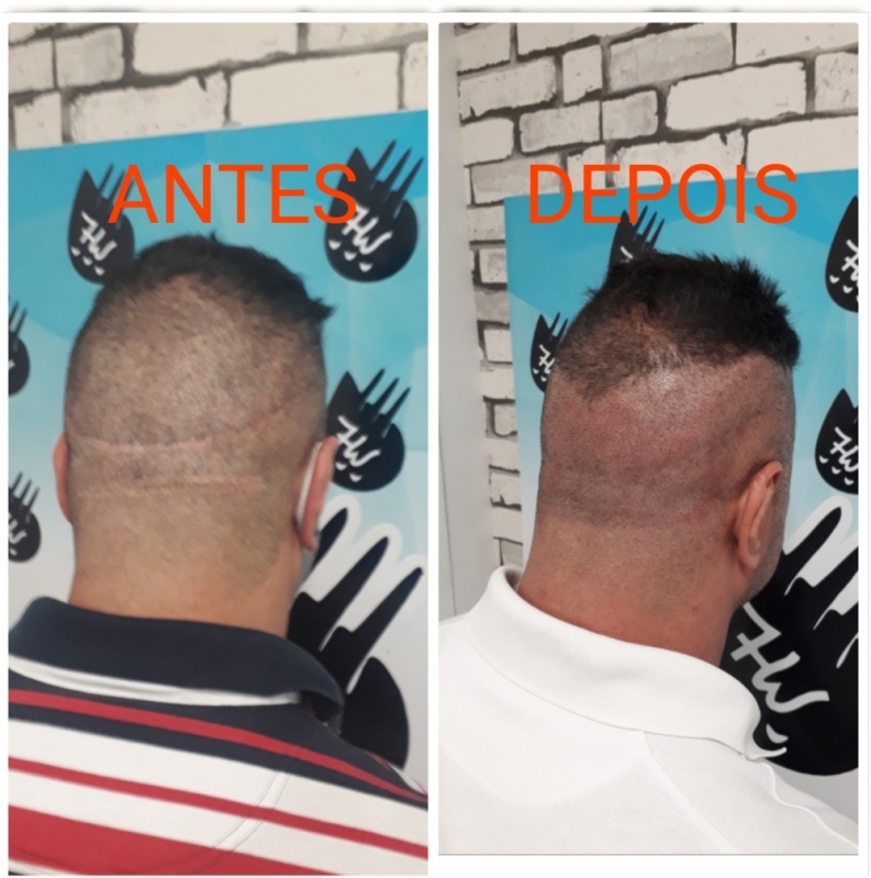 Preço de Micropigmentação Preenchimento Cabelo Itapevi - Micropigmentação Cabelo Feminino