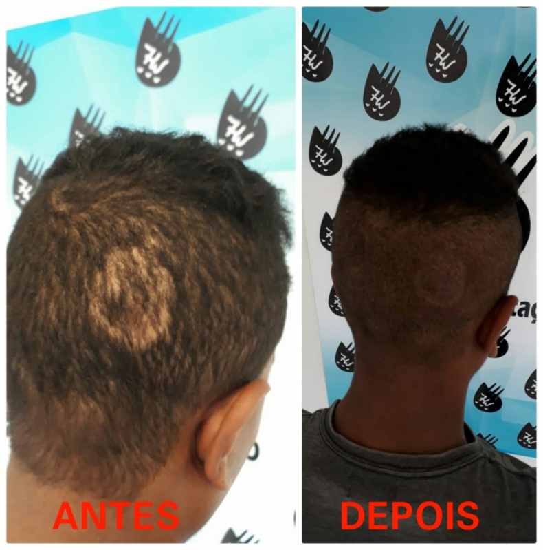 Preenchimento Capilar Central Valor Mooca - Preenchimento Capilar Masculino