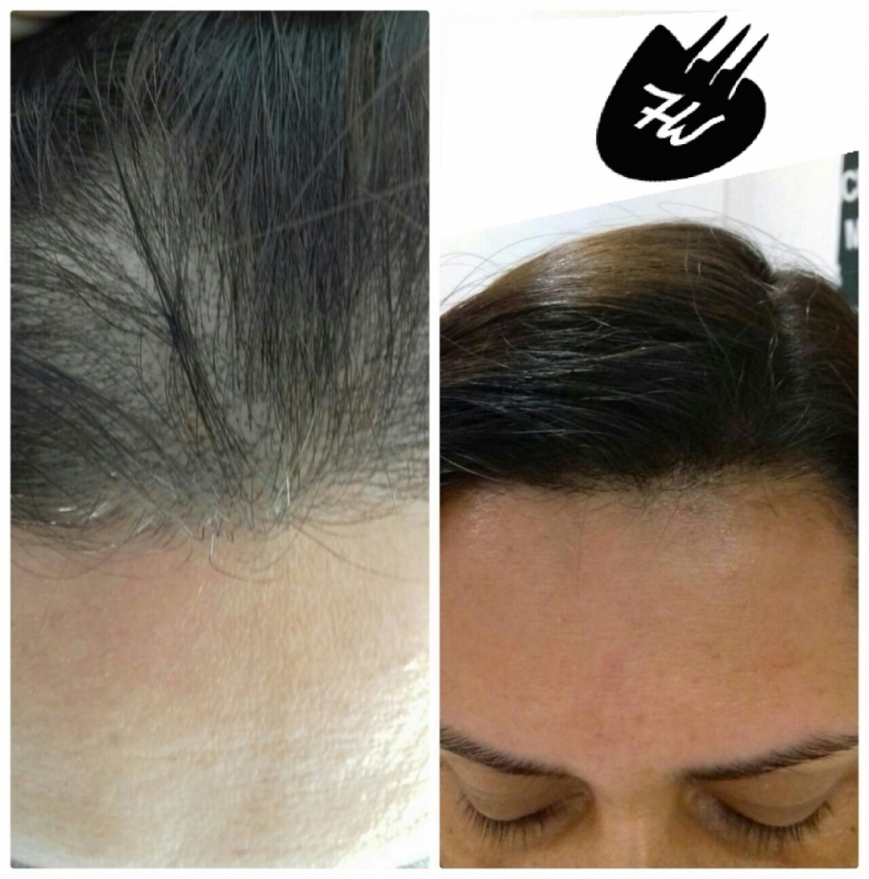 Preenchimento Capilar em Mulheres Preço Jabaquara - Preenchimento Capilar nas Entradas