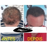 clínica de micropigmentação cabelo masculino Perus