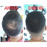 clínica de micropigmentação cabelo Santos