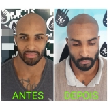 clínica de micropigmentação de cabelo 3d São Mateus