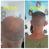 clínica de micropigmentação fio a fio cabelo Cajamar