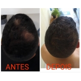 clínica de micropigmentação no cabelo Ermelino Matarazzo
