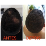 clínica de micropigmentação no cabelo Perdizes