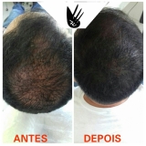 clínica de pigmentação de couro cabeludo São Vicente