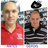 clínica de pigmentação na careca Tatuapé