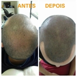clínica de pigmentação no couro cabeludo em sp Santo Amaro