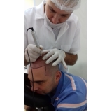 clínica de pigmentação no couro cabeludo Cambuci
