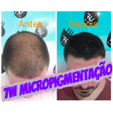 clinica que faz nano pigmentação na barba Vila Curuçá