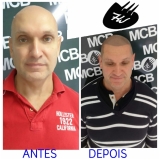 clínicas de micropigmentação capilar Santos