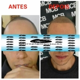 clinicas-de-pigmentacao-capilar-clinica-de-micropigmentacao-capilar-em-3d-clinica-de-micropigmentacao-capilar-em-3d-em-sp-jandira