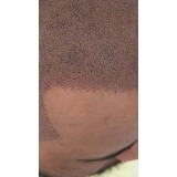 clínicas de pigmentação capilar em 3d Tatuapé