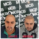 clínicas de pigmentação capilar para homens Biritiba Mirim