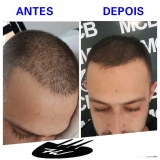 clínicas de pigmentação de couro cabeludo São Bernardo do Campo