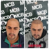 clínicas de pigmentação na careca Arujá