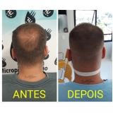 micropigmentação cabelo feminino valor Jardim Iguatemi