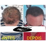 micropigmentação cabelo homem preço Peruíbe