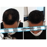 micropigmentação cabelo masculino agendar Cidade Tiradentes