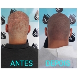 micropigmentação cabelo masculino Santana de Parnaíba