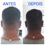 micropigmentação capilar cabelo branco agendar Vila Leopoldina