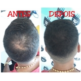 micropigmentação capilar cabelo branco Brooklin