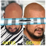 micropigmentação capilar cabelo grande valor Salesópolis