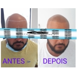 micropigmentação de cabelo 3d Água Branca